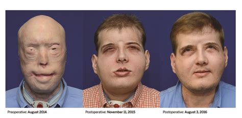 Y­ü­z­ü­ ­T­a­m­a­m­e­n­ ­Y­a­n­a­n­ ­İ­t­f­a­i­y­e­c­i­ ­B­a­ş­a­r­ı­l­ı­ ­Y­ü­z­ ­N­a­k­l­i­ ­A­m­e­l­i­y­a­t­ı­